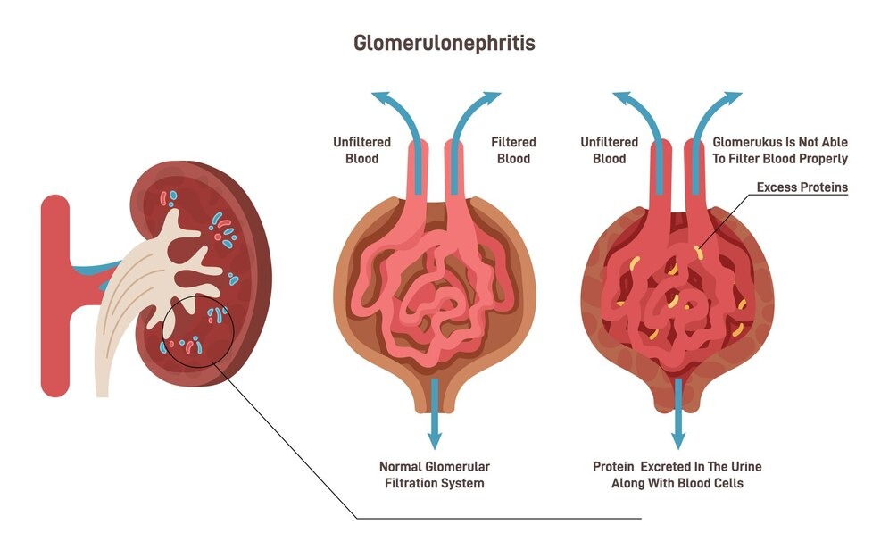 Glomerulonephritis treatment in Greater Noida